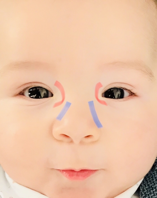 Akių žaizdų masažas kūdikiams