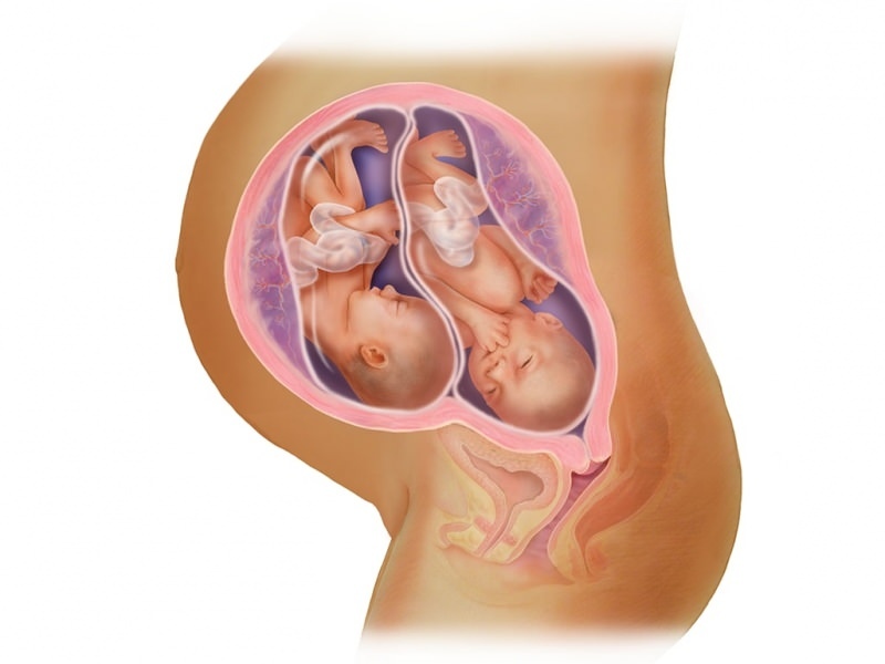 Dvynių nėštumas sergant IVF! Kas yra embrionų perkėlimas?