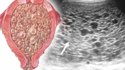 Kas yra molinis nėštumas (vynuogių nėštumas), kokie simptomai? Kaip suprasti molinį nėštumą?