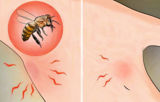 Kas yra bičių alergija ir kokie simptomai? Natūralūs metodai, tinkami bičių įgėlimui