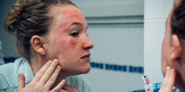 jos atsiranda ant peršalimo alergija sergančio žmogaus odos