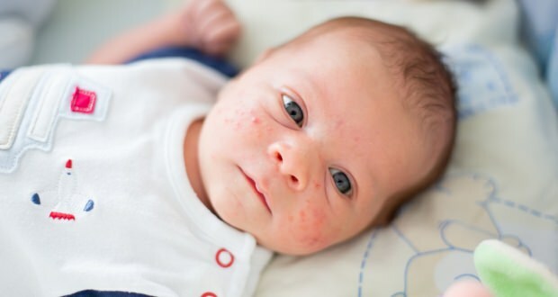 Kaip spuogai praeina ant kūdikio veido? Spuogų (Milia) džiovinimo būdai