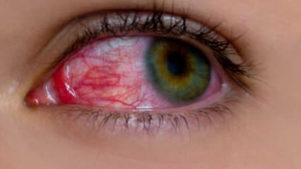Kas sukelia akių alergiją? Kokie yra akių alergijos simptomai? Kas naudinga akių alergijai? 