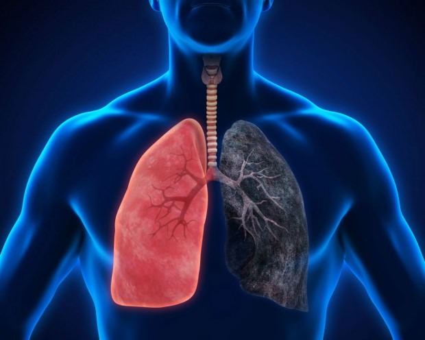 kas yra plaučių vėžys
