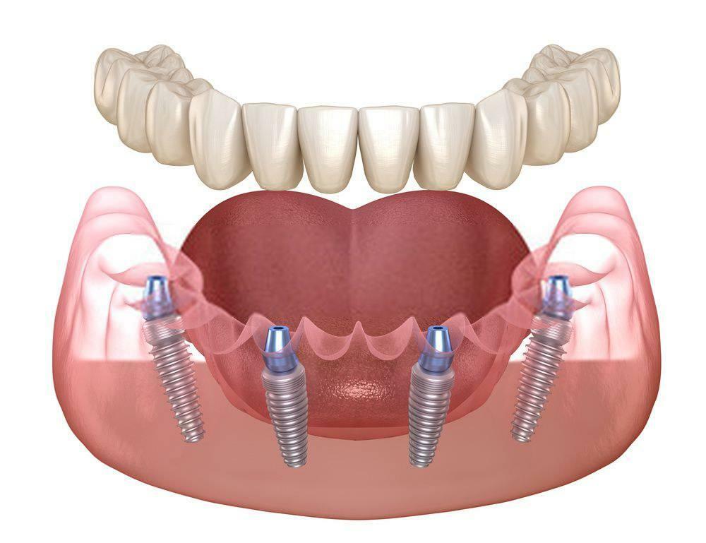 AR GALIU ĮDĖTI IMPLANTĄ IŠ karto PO DANTIES IŠRAUKIMO?