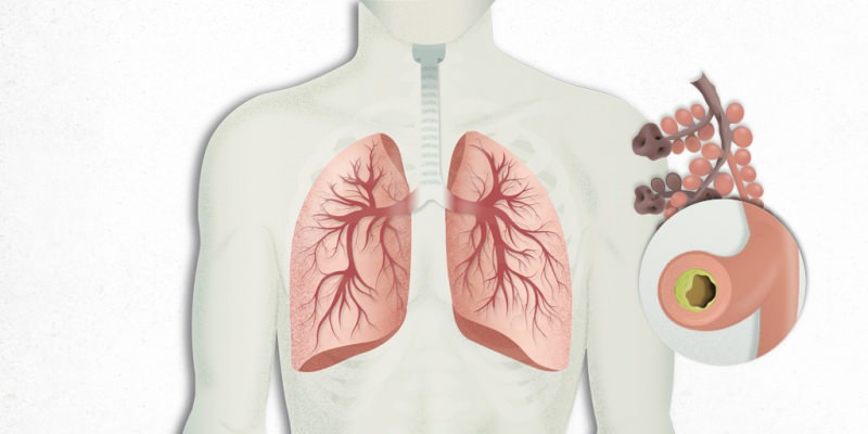 virusas, įsikuriantis plaučiuose, yra maišomas su plaučių uždegimu