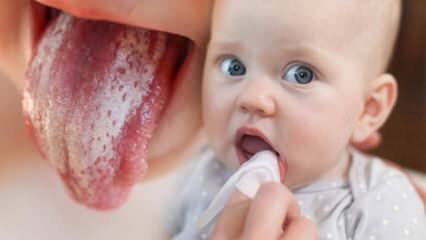 Kūdikių pienligės simptomai ir gydymas! Kaip pienligė perduodama kūdikiams? Tikslus sprendimas ...