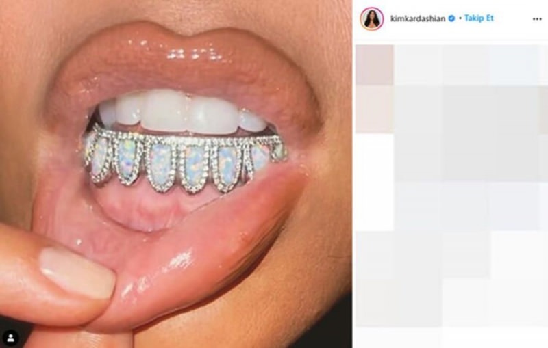 Kim Kardashian 5000 dolerių vertės dantų perlas