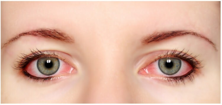 Ar tušas ir akių pieštukas alergiški akims?