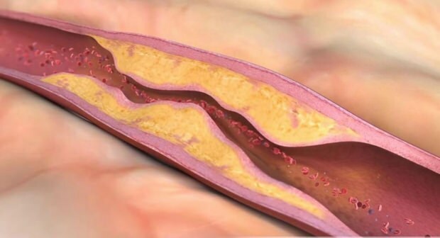 Kas sukelia aterosklerozę? Kiek yra kraujagyslių okliuzijos tipų?