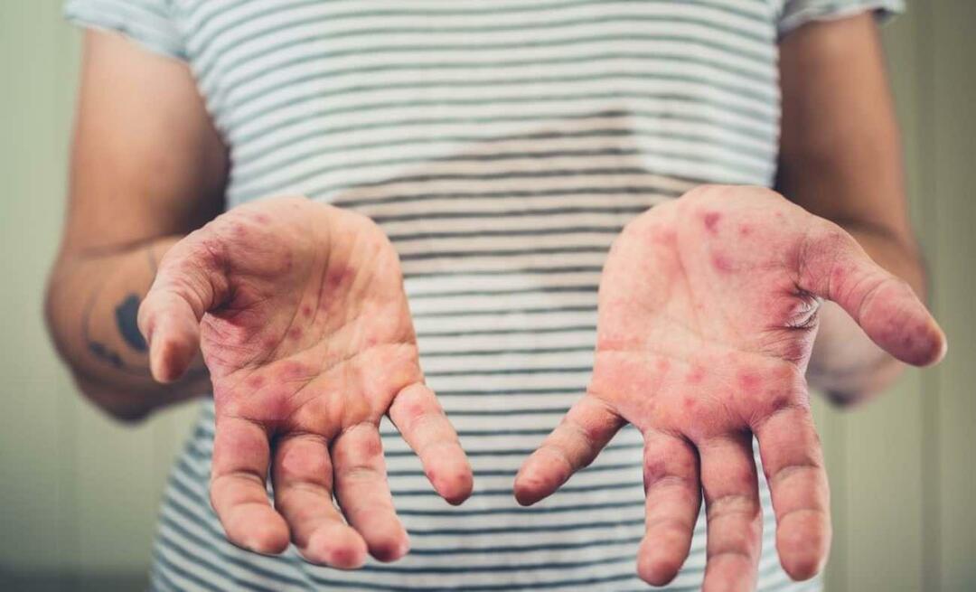 Kokia yra Burcu Kara sūnaus liga? Kokie yra rankų, snukio ir nagų ligos simptomai? 
