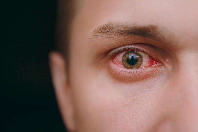 akių laistymas, kraujavimas ir niežėjimas koronaviruso simptomai