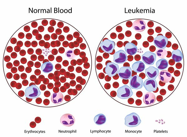 kas yra leukemija