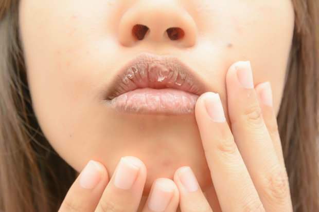 anemija sukelia sausas lūpas