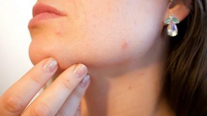 Kas yra odos vėžys (melanoma)? Kokie yra melanomos simptomai ir ar yra gydymas?