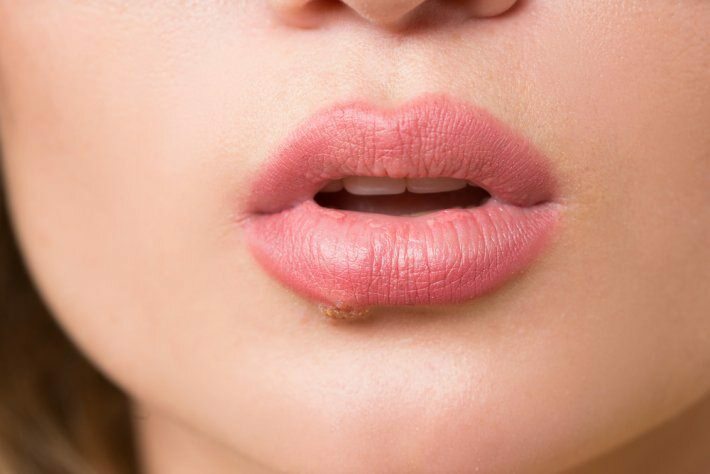 Kas yra liežuvio vėžys? Kokie simptomai?
