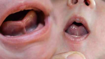 Kokia yra liežuvio jungtis (Ankyloglossi) kūdikiams? Liežuvio simptomai ir gydymas ...