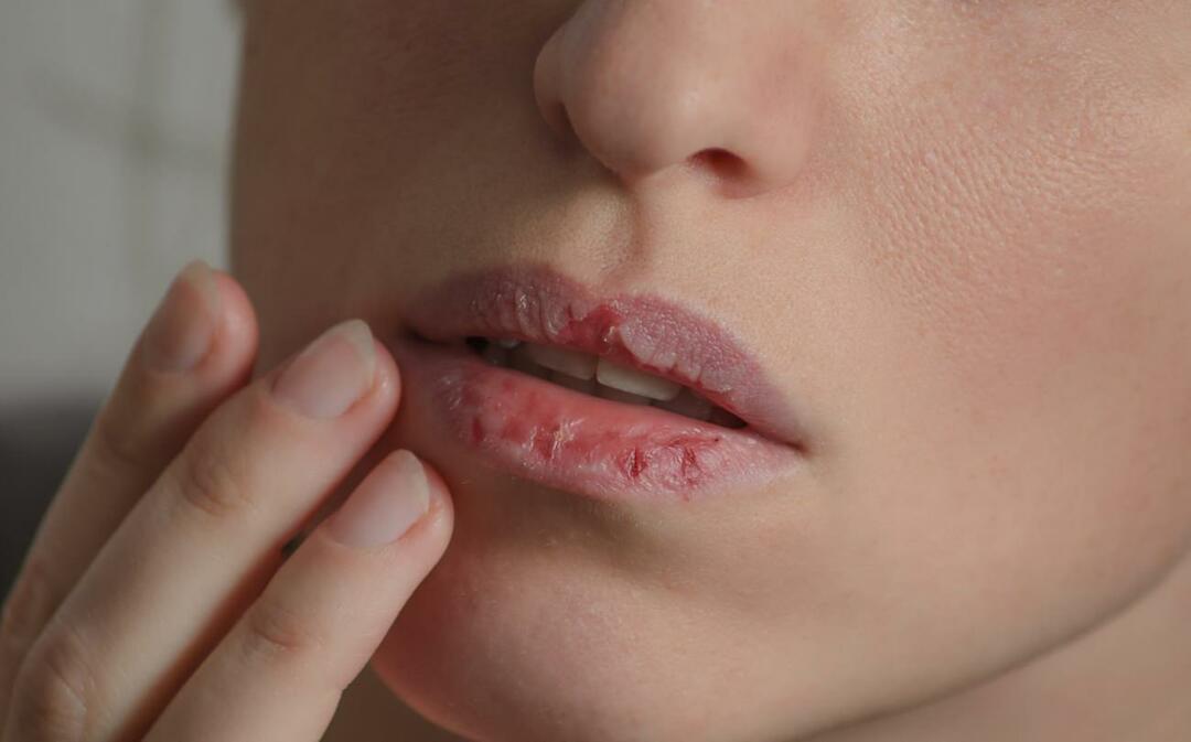Kas sukelia tamsias lūpas? Kaip gydomas lūpų patamsėjimas ar mėlynės?