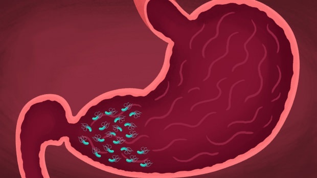 kai kurie virusai ir bakterijos gali sukelti gastritą