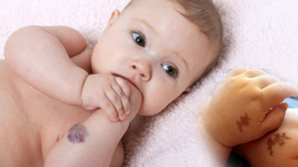 Sukelia apgamą kūdikiams, ar jis yra nuolatinis? Kokios yra apgamų rūšys? Gydymas iš Saracoglu