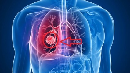 Plaučių vėžio simptomai: plaučių vėžio stadijos!