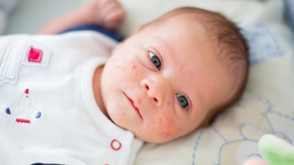 Kaip vyksta spuogai ant kūdikio veido? Spuogų (Milia) džiovinimo būdai