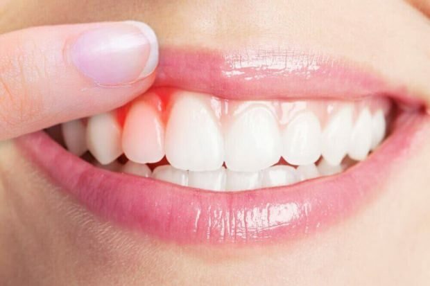 Kas sukelia dantenų kraujavimą?