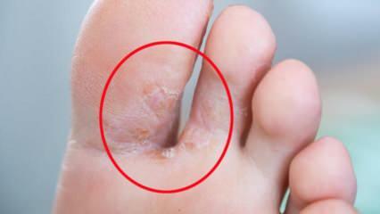 Kas yra pėdų grybelis? Kokie yra sportinės pėdos simptomai? Sportinės pėdos gydymas 