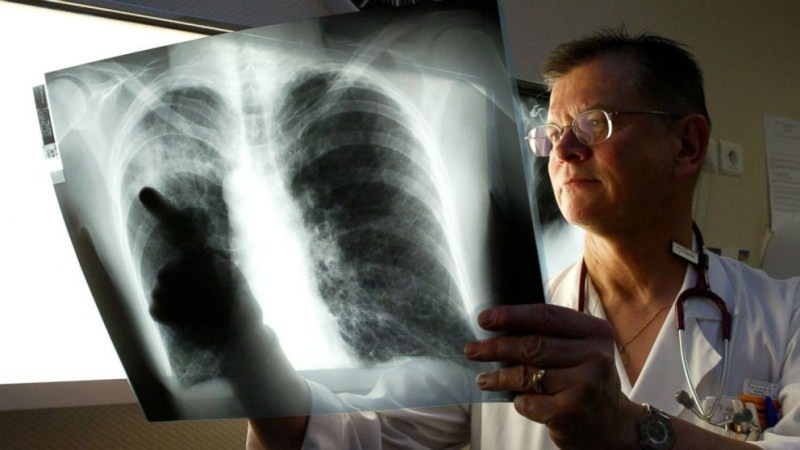 legioneliozės virusas įsikuria plaučiuose 