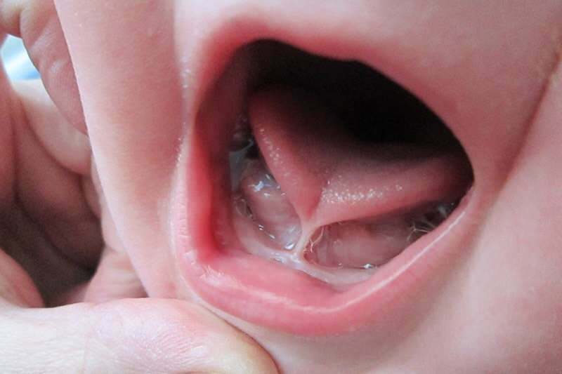 Kūdikių liežuvio jungties simptomai ir gydymas