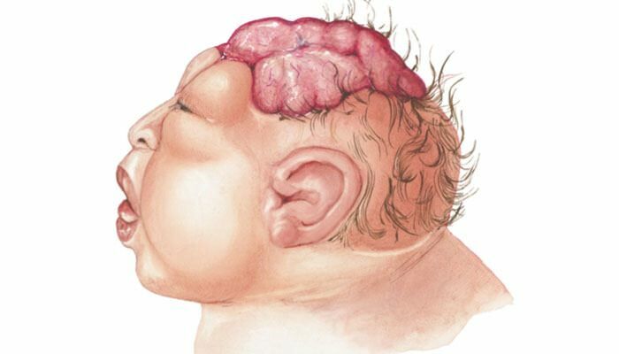 Kas yra anencefalija? Kokie yra anencefalijos simptomai kūdikiams ir vaikams? Anencefalija sukelia ...