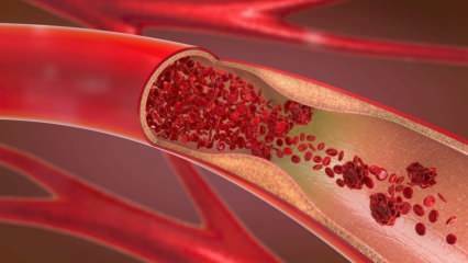 Kas yra anemija (anemija)? Nuolatinis silpnumas rodo anemiją! Maistas, tinkamas mažakraujystei ...