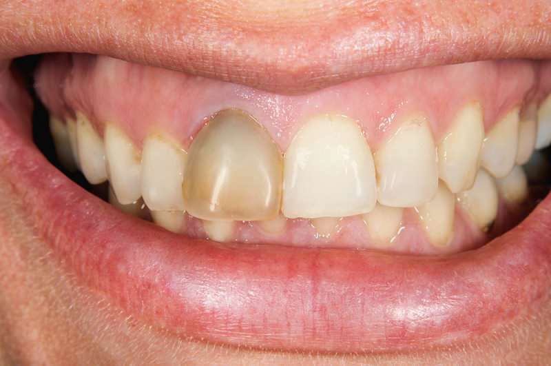 dantų patamsėjimas kartais gali sutelkti dėmesį į vieną dantį