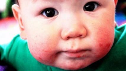 Kaip burnos opos praeina kūdikiams? Intraoralinių žaizdų simptomai ir gydymo namuose metodai