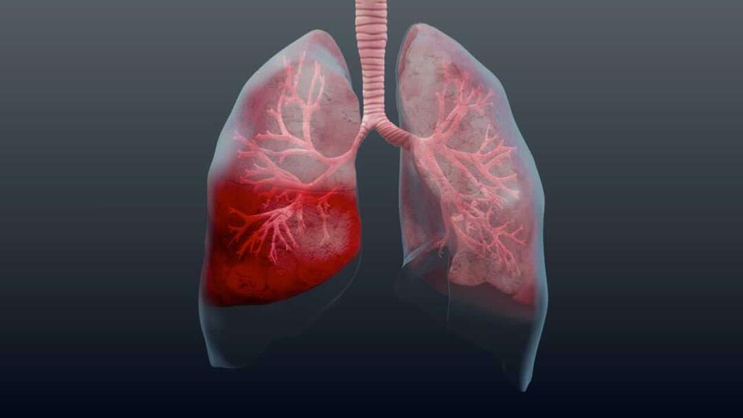 Kas yra pneumonija ir kokie jos simptomai? Kaip gydomas naujas epideminis pneumonijos virusas?