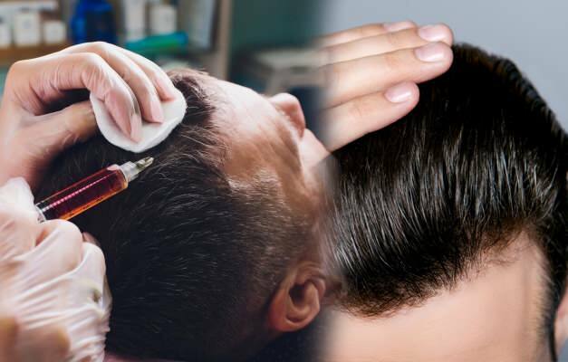 Ar leidžiama plaukus persodinti? Kas yra plaukai protezuoti?