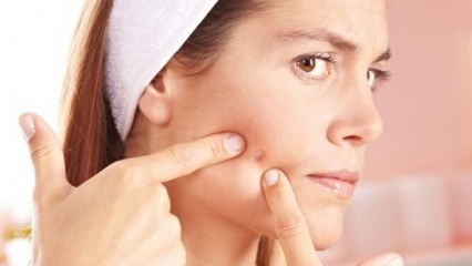 Natūralios spuogų odos priežiūros priemonės