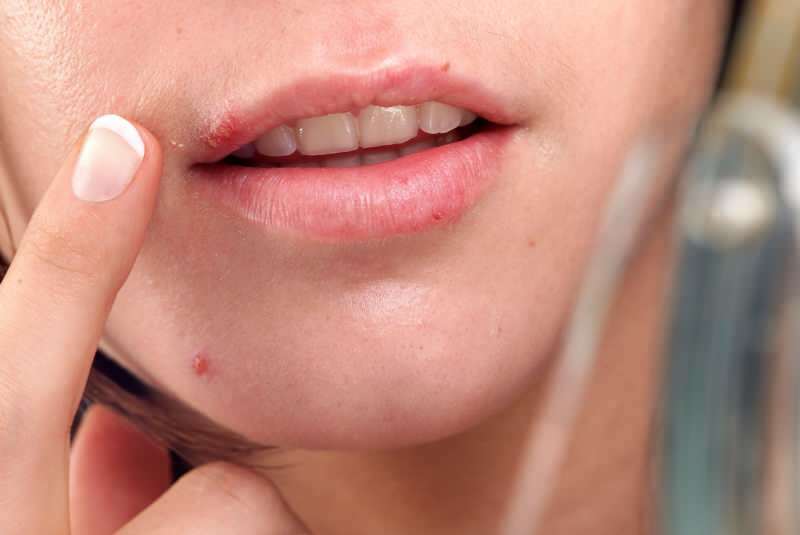 herpesas dažniausiai iškyla ant lūpos krašto.
