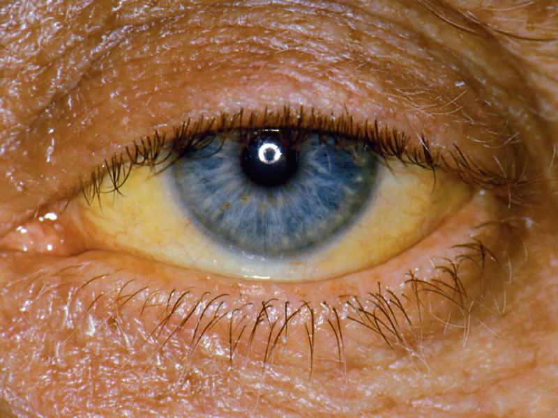 ūgis bilirubino lygiu sukelia geltoną akių ir odos spalvą