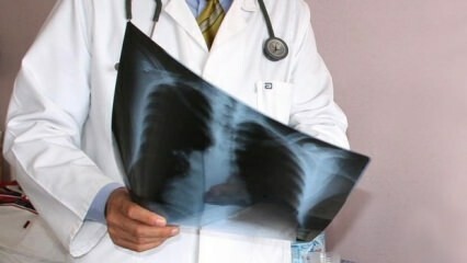 Ekspertai paskelbė! Mirčių dėl plaučių vėžio padažnėjimas
