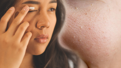 Kas yra Milia? Kaip gydyti miliją namuose? Kaip praeina veido odos liaukos?