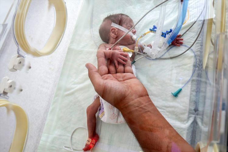 „Stebuklingas kūdikis“ sugebėjo išgyventi po operacijos