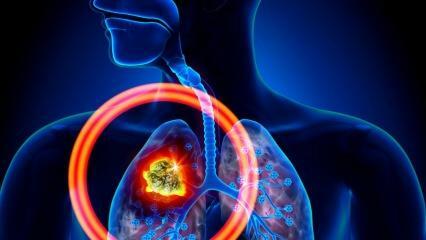 Kokie yra plaučių vėžio simptomai? Ar yra plaučių vėžio gydymas?