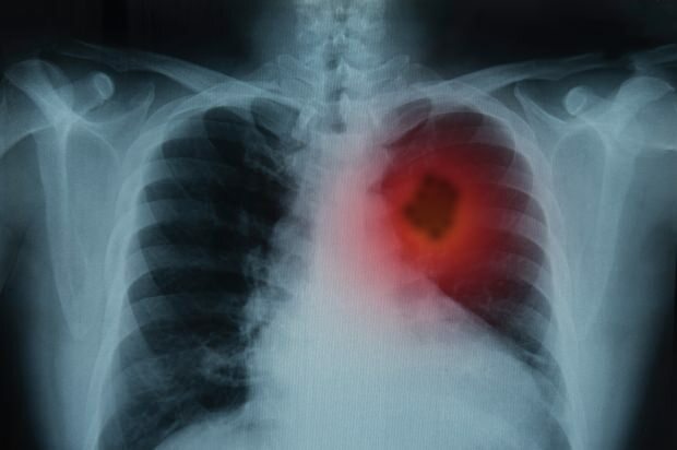 Kokie yra plaučių vėžio simptomai? Ar yra plaučių vėžio gydymas? Norėdami išvengti plaučių vėžio ...