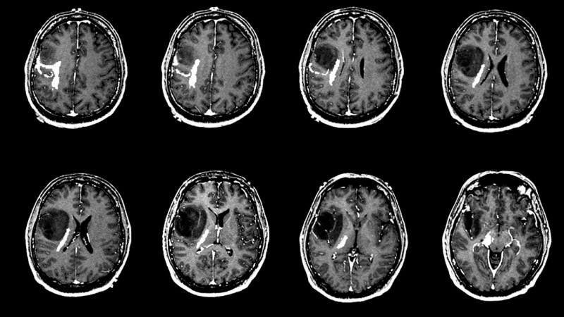 Kas sukelia smegenų naviką? Kokie yra smegenų naviko simptomai? Ar sunku gydyti smegenų auglį?