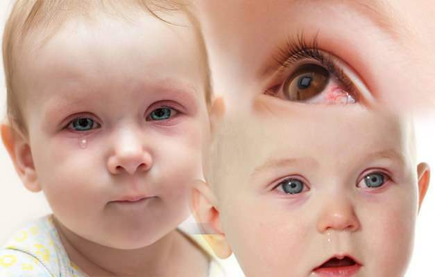 sukelia kūdikių akių kraujavimą