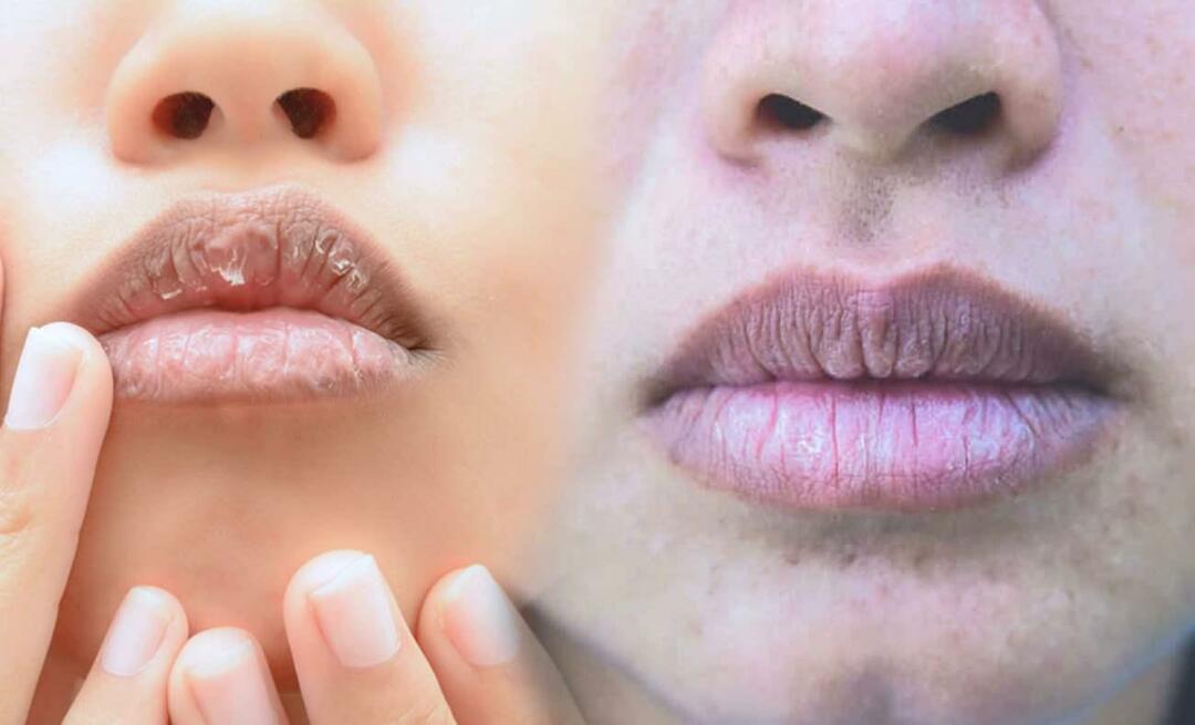 Kas sukelia tamsias lūpas? Kaip gydomas lūpų patamsėjimas ar mėlynės?