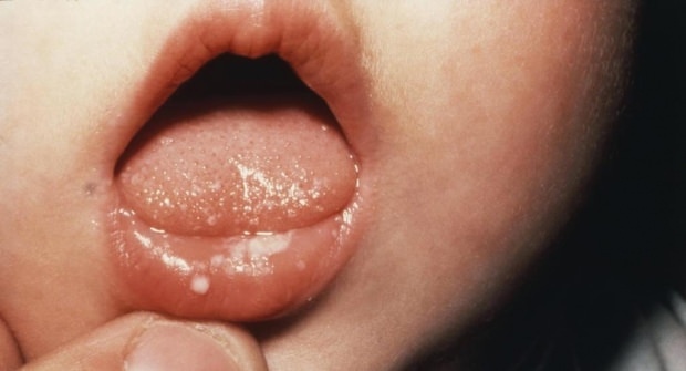 Kaip skauda burną kūdikiams