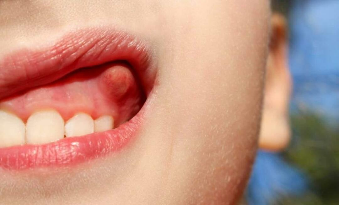 Kodėl atsiranda danties abscesas ir kokie simptomai? Dantų abscesas, kaip jis gydomas?