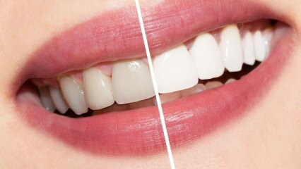 Kokios yra baltų dantų rekomendacijos? Dantų balinimas natūraliai išgydo namuose ...